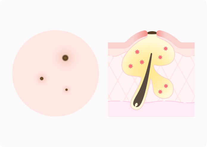 黒ニキビの模式図