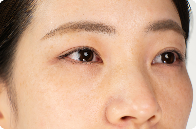 頬の雀卵斑（そばかす）の例